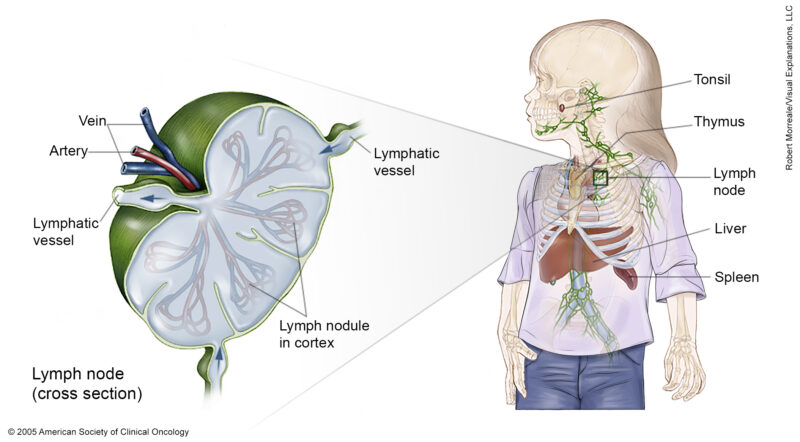 Burkitt lymphoma