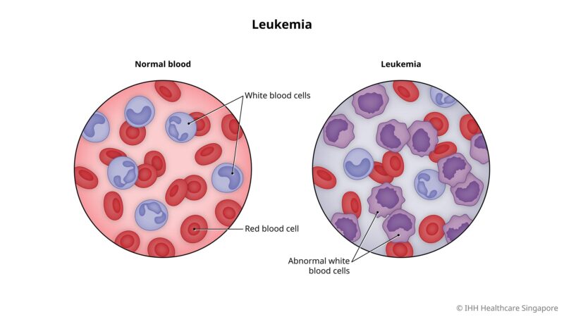 Acute lymphoblastic leukemia affects white blood cells called lymphocytes.