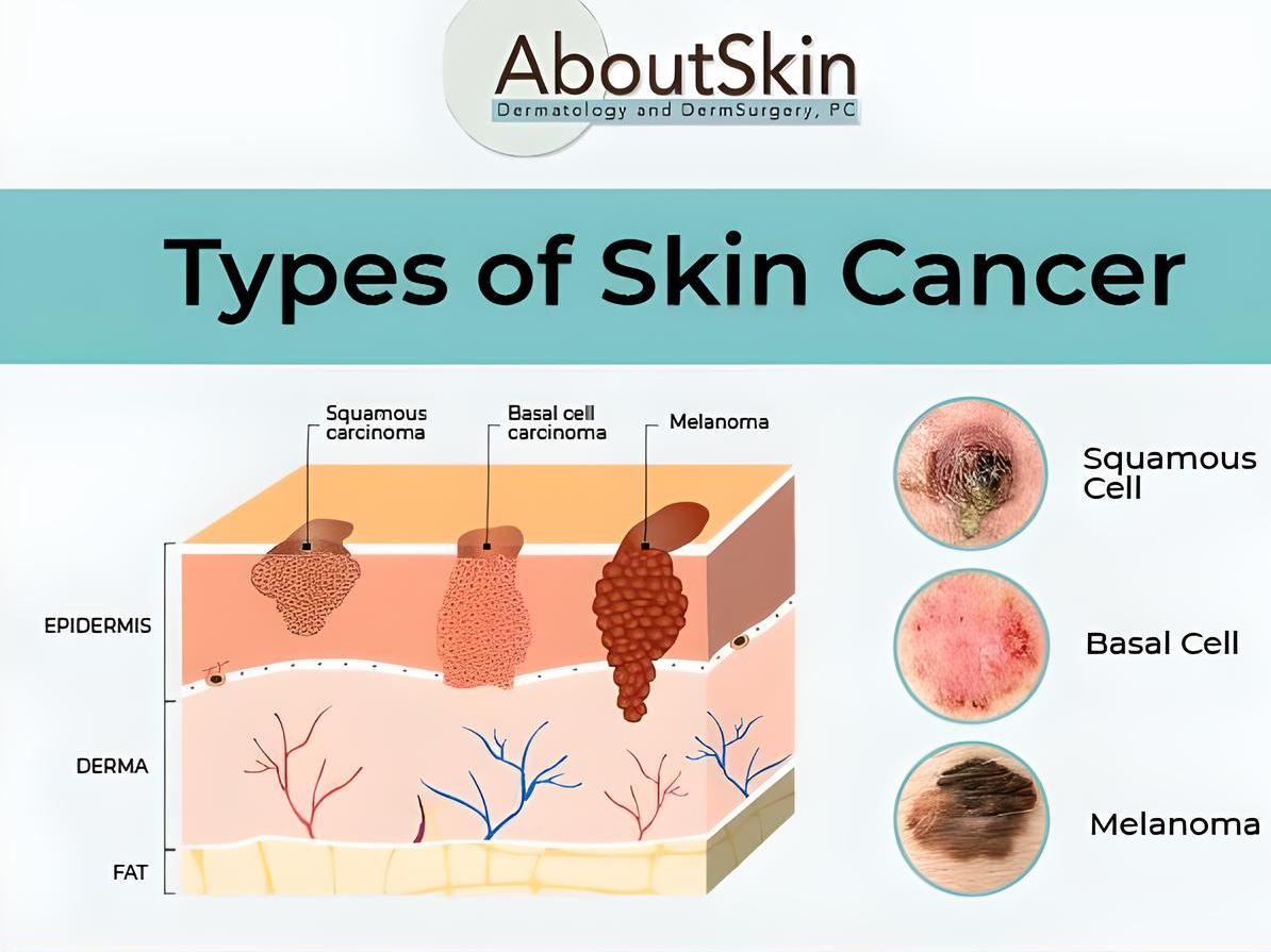 Shahrin Ahmed: The progression of melanoma can be rapid