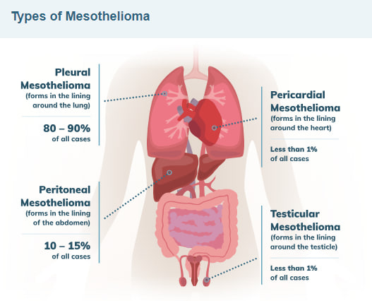 Mesothelioma in Adults: What patients should know about