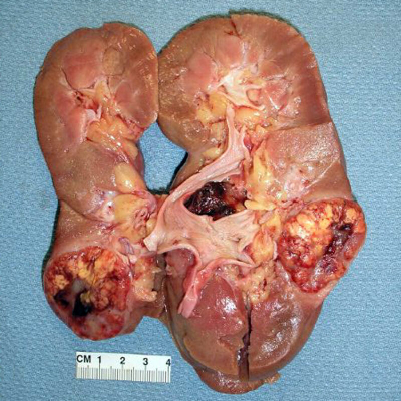 Renal cell carcinoma (gross pathology)