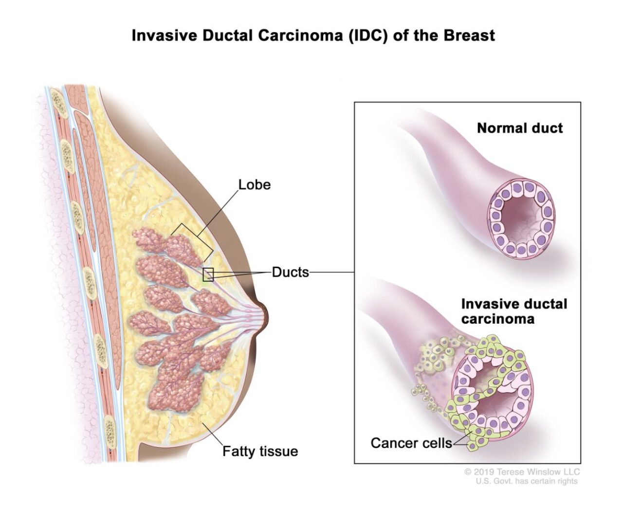 Native Hawaiian and Pacific Islander populations and higher rates of inflammatory breast cancer – NCI Center for Cancer Research