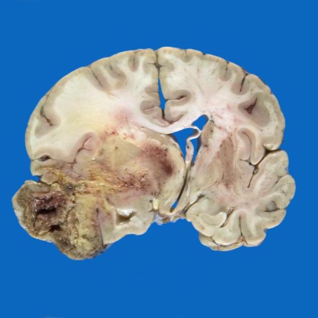 Glioblastoma in Adults: What patients should know about