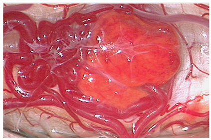 Hemangioblastoma