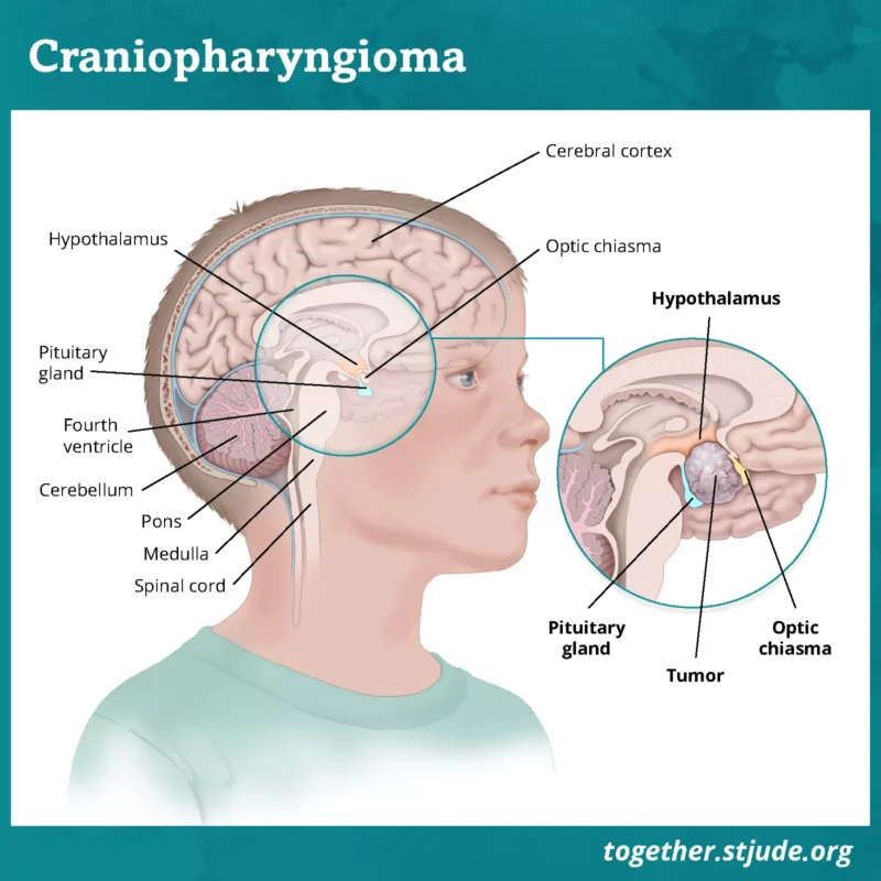 Craniopharyngioma in Children: What patients and caregivers should know about