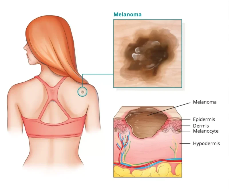 Melanoma