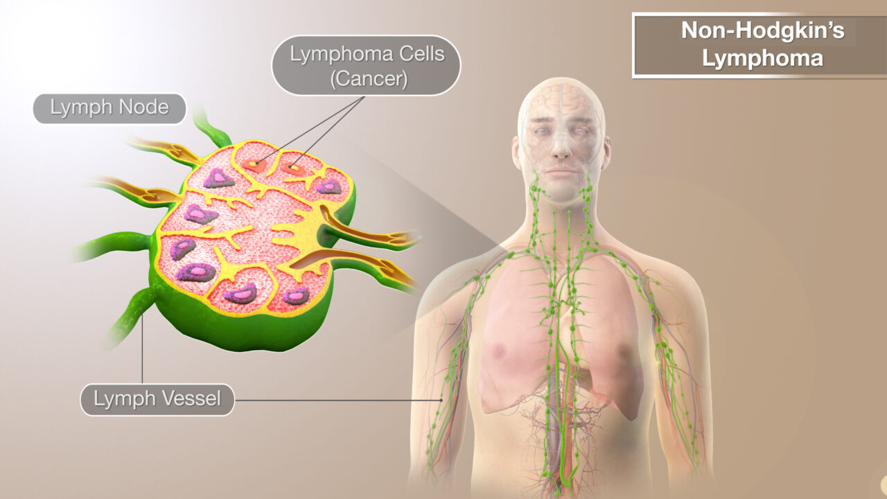 Annals of Research in Oncology – Case study on extranodal non-Hodgkin B-cell marginal zone lymphoma