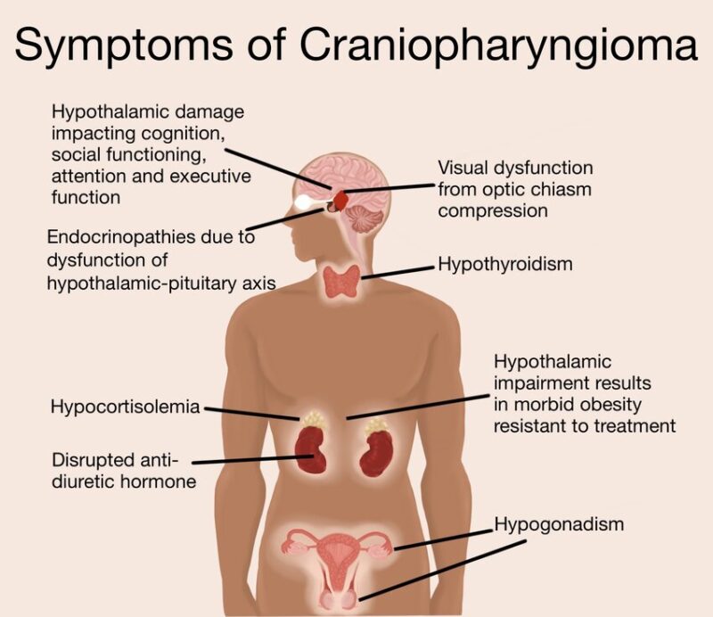 Craniopharyngioma in Adults