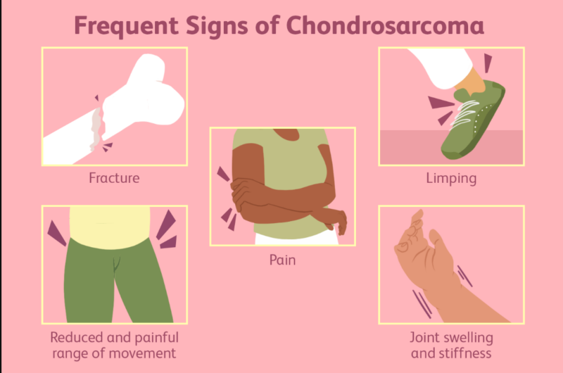 Chondrosarcoma