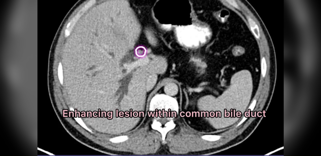 A case of cholangiocarcinoma type IV block from Kazakistan