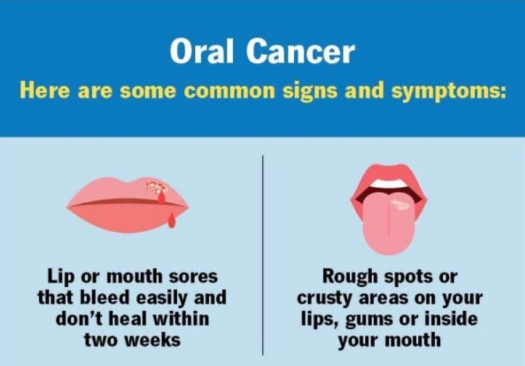 Shahrin Ahmed: The UK is seeing an increase in the number of cases of mouth cancer