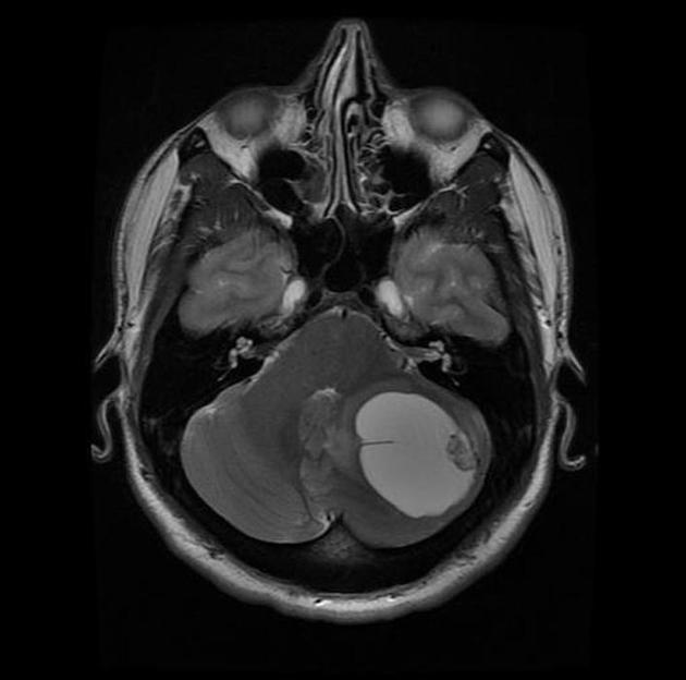 Hemangioblastoma