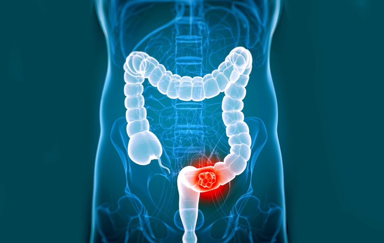 An expert’s take on colorectal cancer highlights