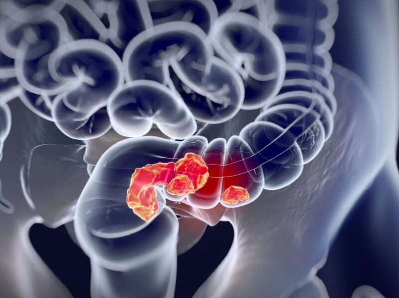 Annals of Oncology – Long-term results of the UNICANCER-PRODIGE 23 trial