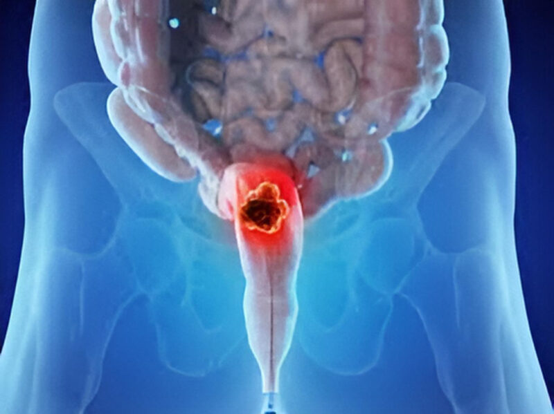 Unanswered questions in TNT and organ preservation of rectal cancer