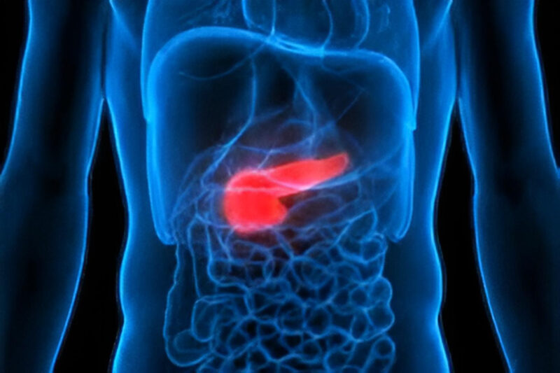 Erman Akkus: Germline mutations are common in non-familial pancreatic cancer