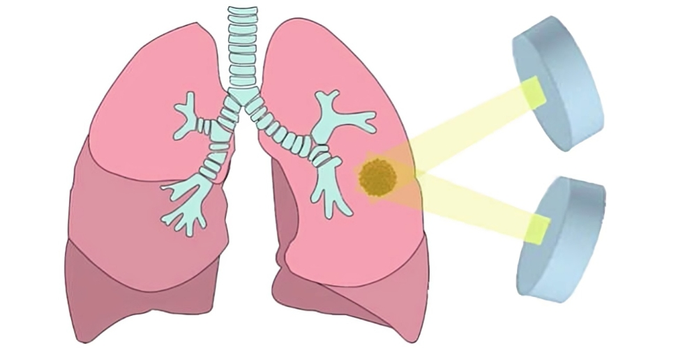 A new review sheds light on radiographic scars developing after lung SBRT