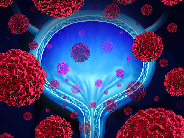 Results from the NIAGARA Phase III trial