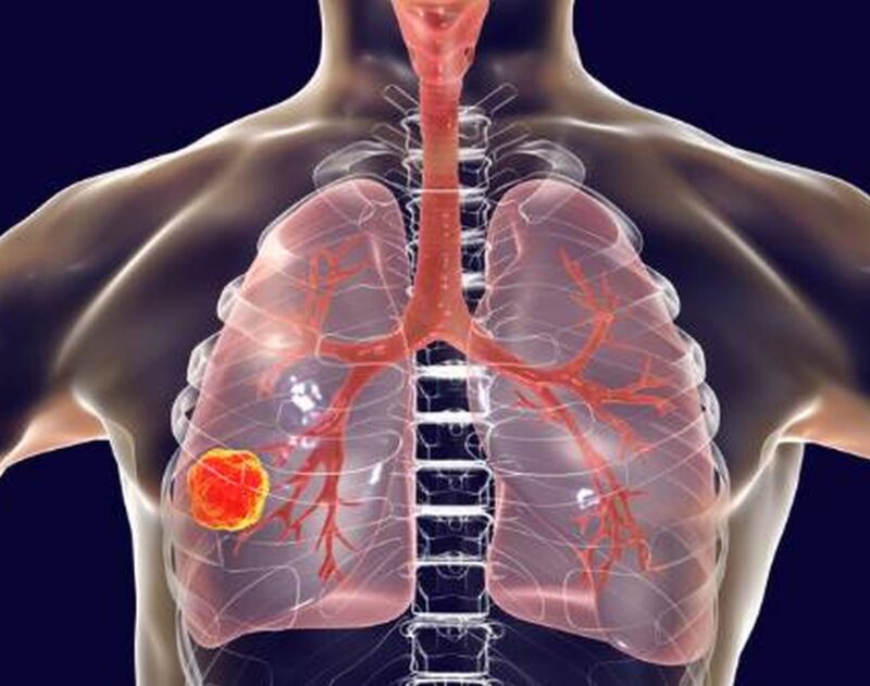 IV vs Subcutaneous amivantamab in EGFR NSCLC