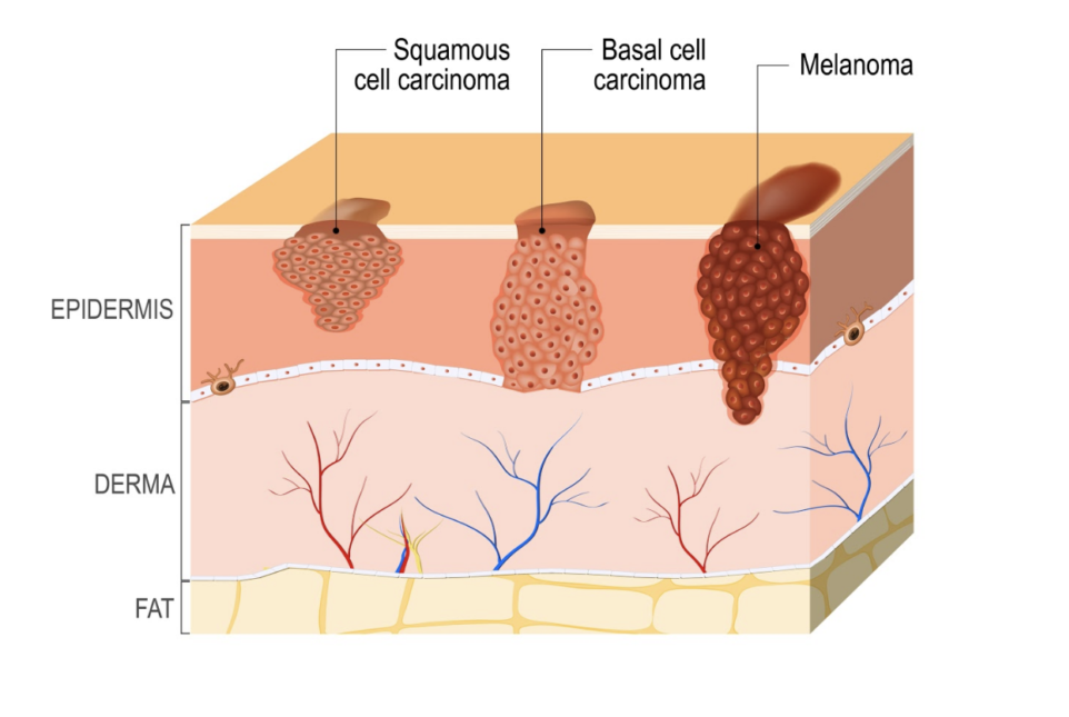 Neoadjuvant treatment in stage III melanoma