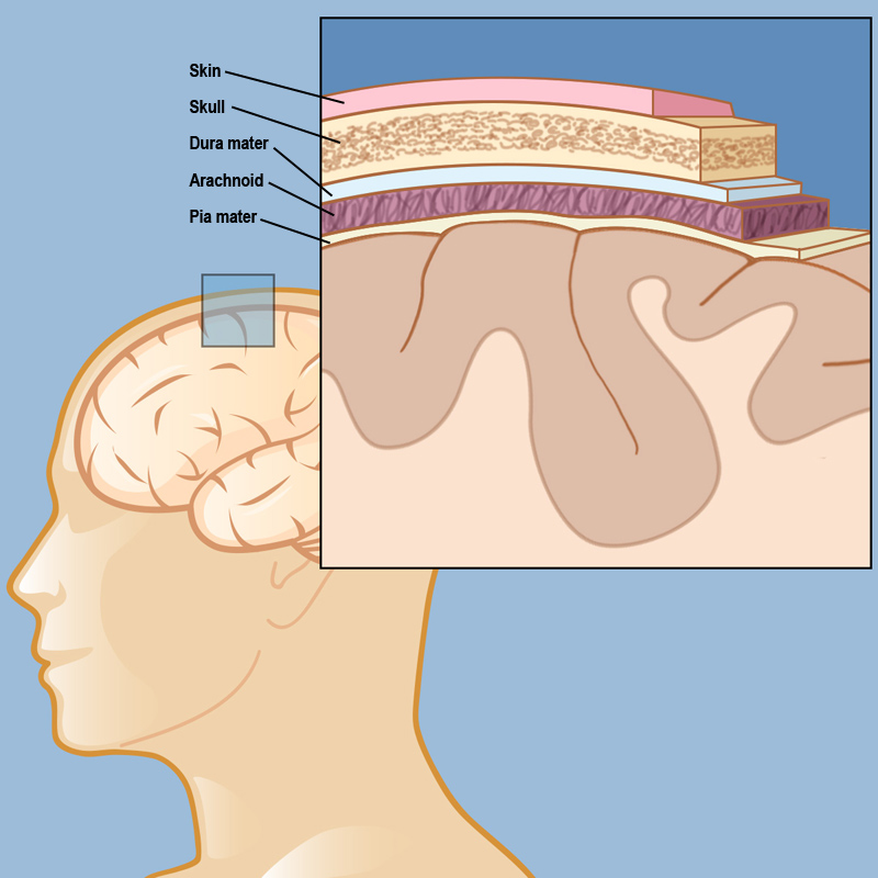 Meningioma in Children