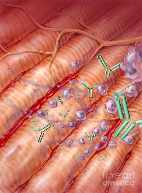 Estela Rodriguez: Underreported toxicity of myopathy from EGFR TKIs