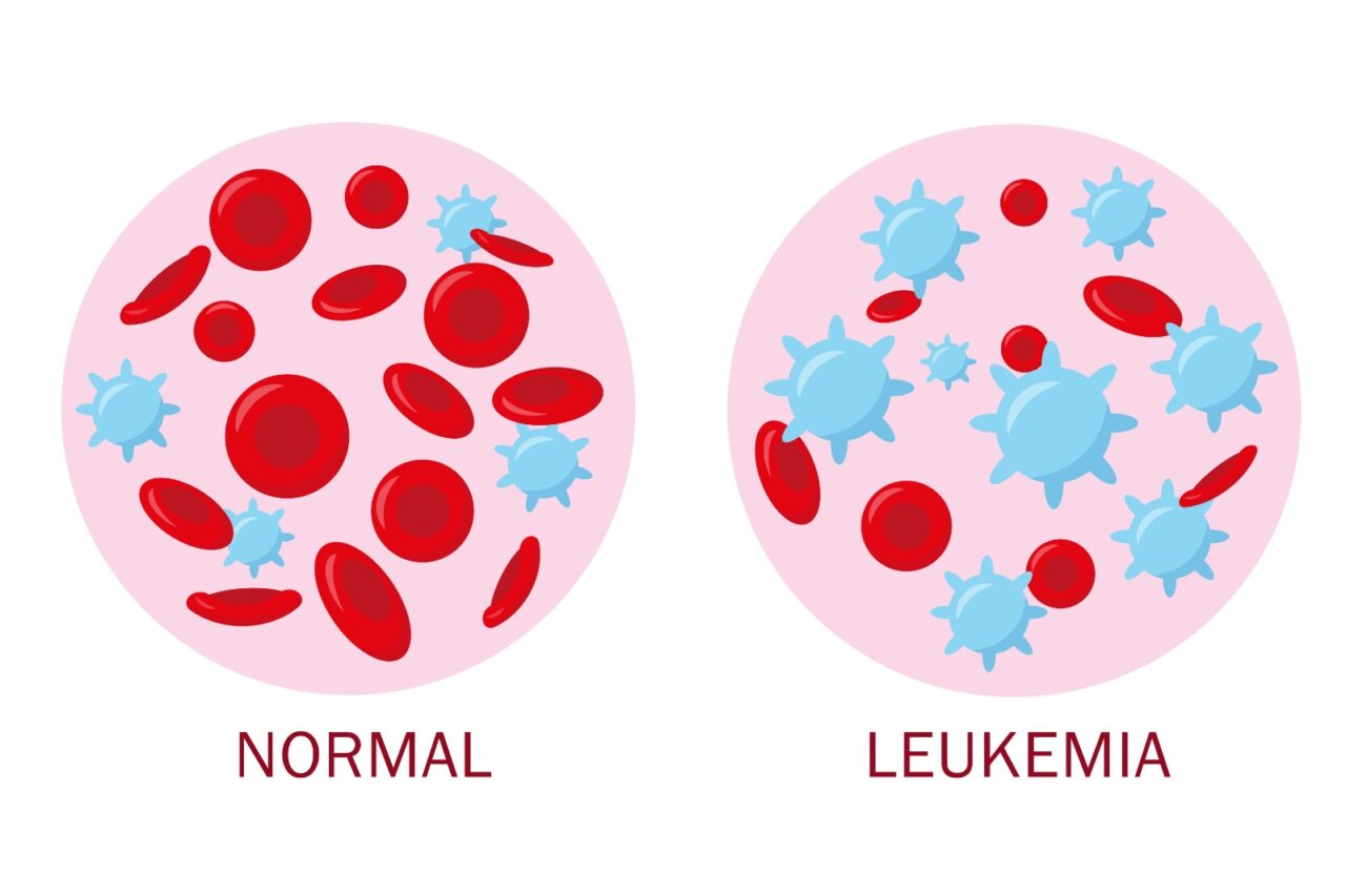 Faheema Hasa: 2025 update on CML diagnosis, therapy, and monitoring