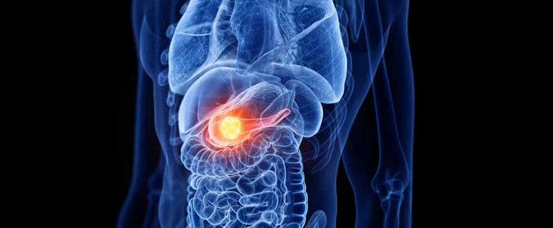 Transcriptomic and genomic analyses in pancretic cancer