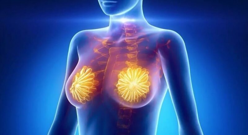 Personalized Dose-Dense Adjuvant Chemotherapy for High-Risk Early breast cancer