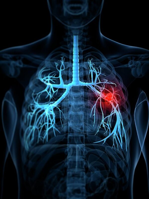 Rami Manochakian: Neoadjuvant osimertinib in stage I-IIIA EGFRm NSCLC did not meet primary endpoint