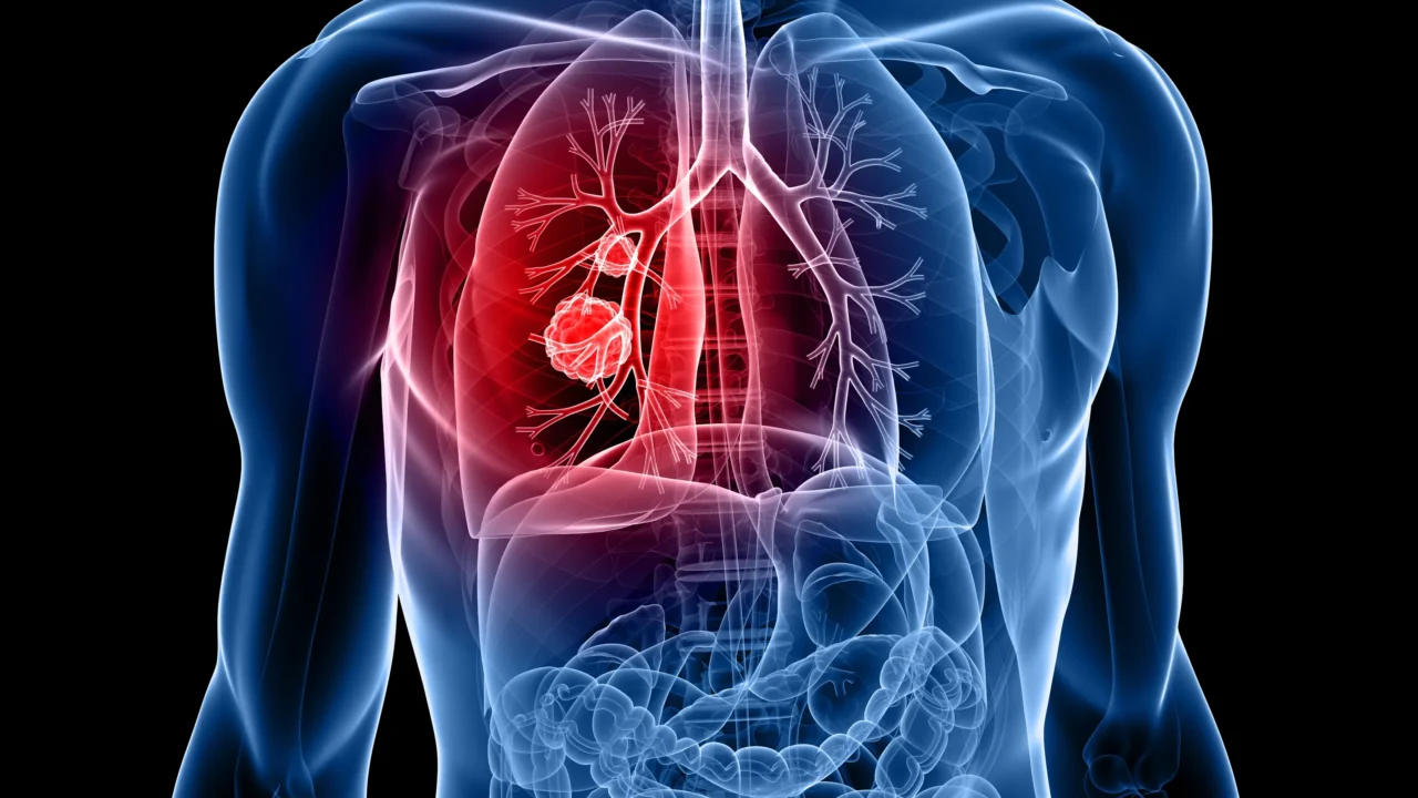 Ralitza Martin: You have lungs? You can develop lung cancer