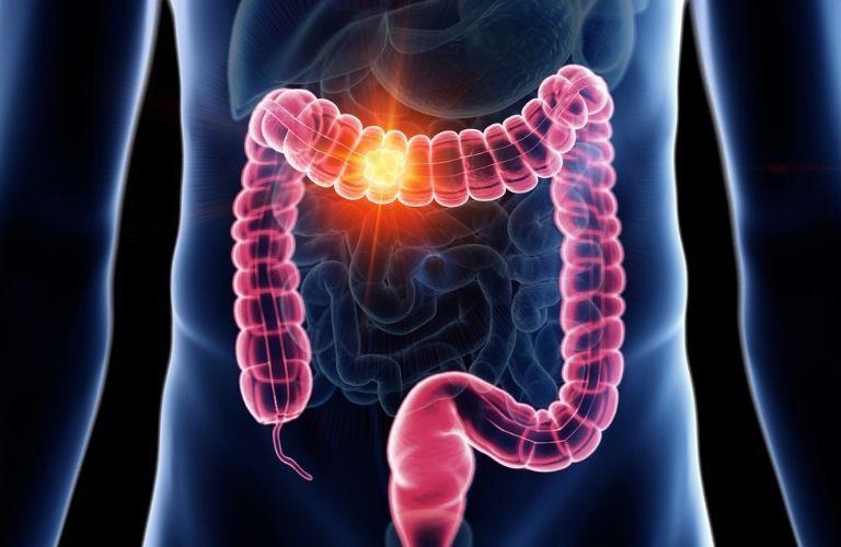 Epigenetic and Oncogenic Inhibitors target KRAS-mutant Colorectal Cancers