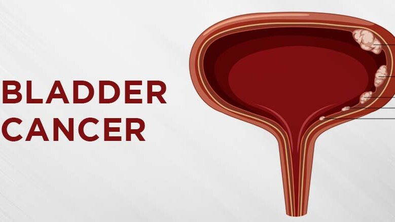 Personalised radiotherapy shows promise in Bladder Cancer – The Institute of Cancer Research