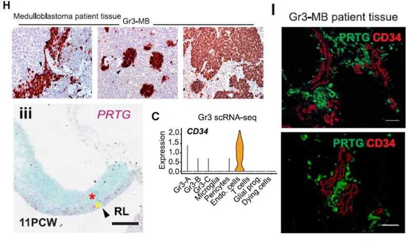 Olivier Saulnier: Cellular origins of medulloblastoma