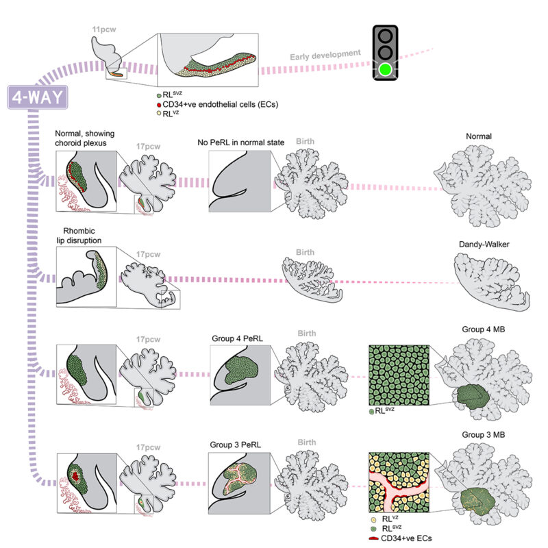 Olivier Saulnier: Cellular origins of medulloblastoma