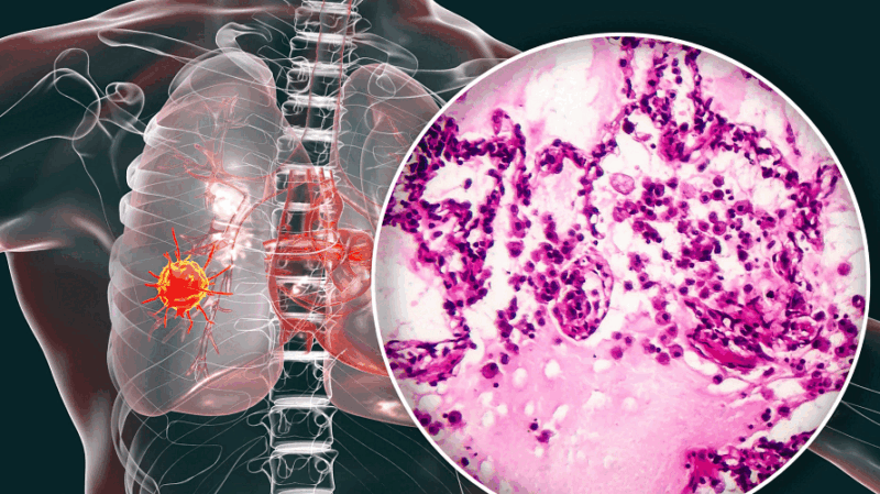 Foritinib in advanced ROS1-rearranged NSCLC in China