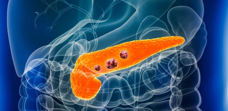 Stromal Interleukin-33 Directs the Pancreatic Microenvironment to Promote Tumor Growth