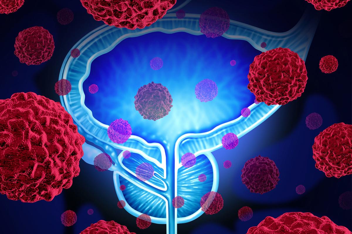 Pierre Blanchard: Silke Gillessen and Bertrand Tombal, on intermittent ADT/ARPI in metastatic prostrate cancer