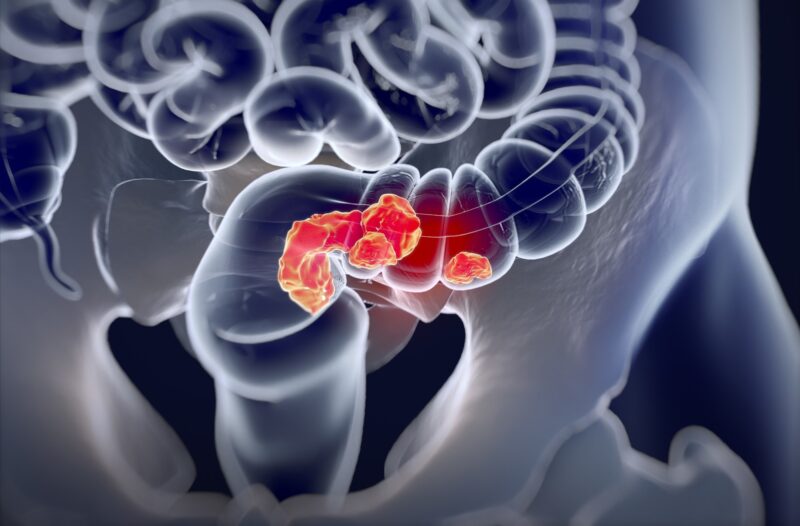 Follow up colonoscopy after positive stool based screening test will improve outcomes in colorectal cancer