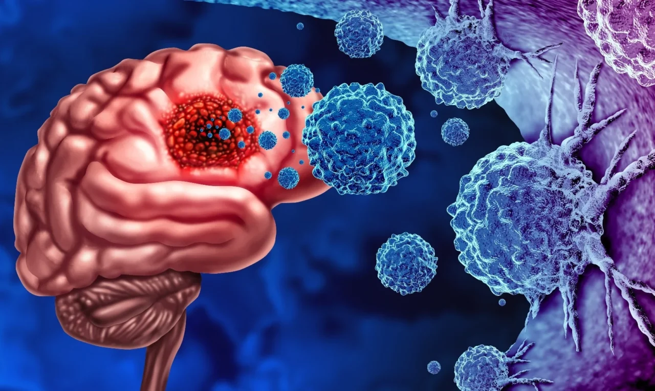 Impactful stats about Glioblastoma – National Brain Tumor Society
