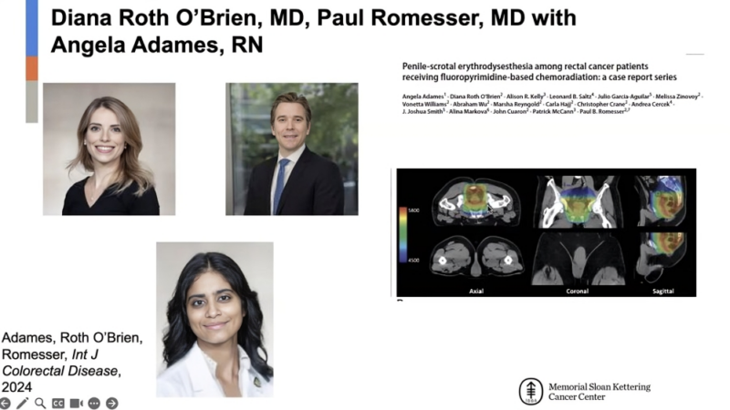 Side effect of fluoropyrimidine-based chemoRT for rectal cancer – Memorial Sloan Kettering Radiation Oncology