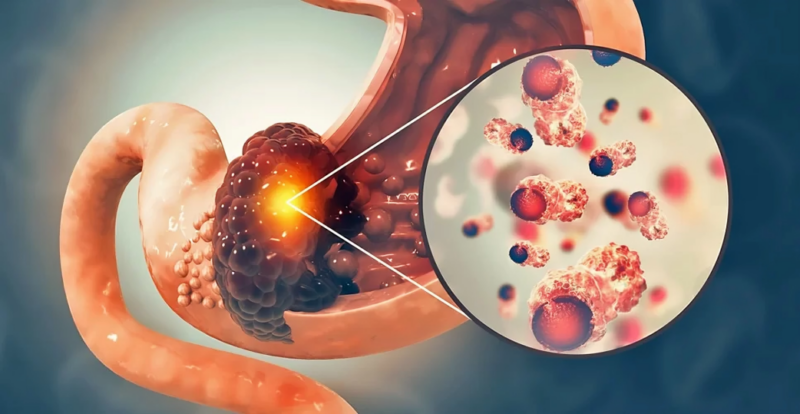 Akhil Kapoor: Intensifying Chemo in advanced Gastric Cancer doesn’t improve survivals