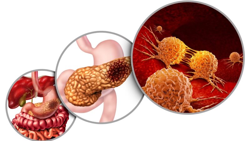 Updates in management of gastroenteropancreatic NETs