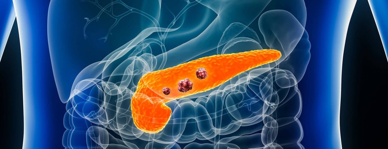 Anirban Maitra: Clinical functional proteomics of intercellular signalling in Pancreatic Cancer