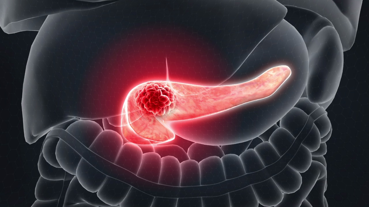 Cancer-associated endocrine cells in pancreatic carcinogenesis