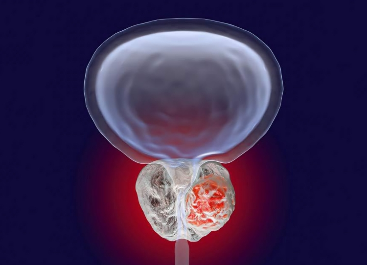 SMA-PET in Biochemically Recurrent Prostate Cancer: A Paradigm Shift