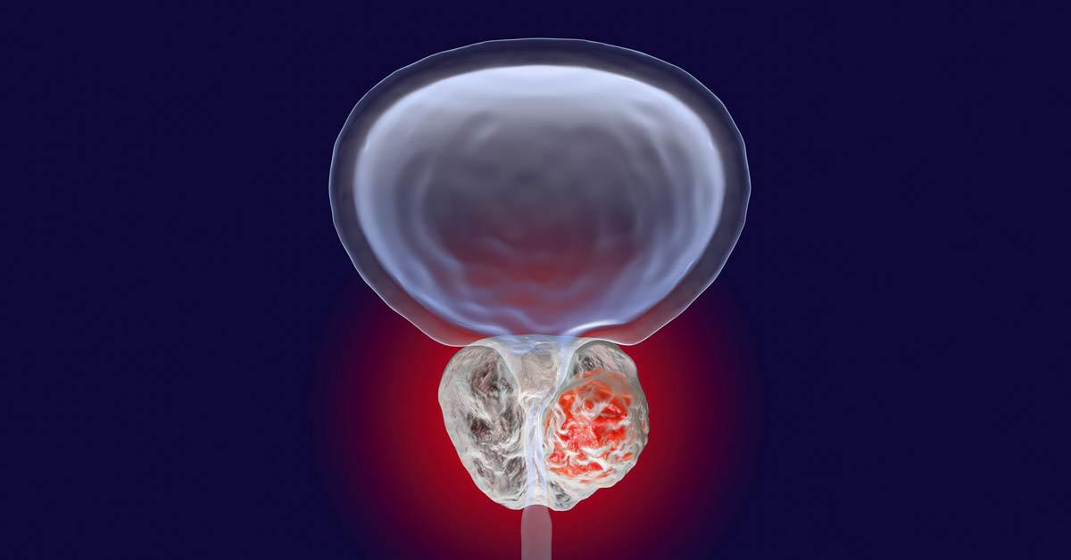 PSADTime ≤6 months Identifies High-Risk BRPC Patients after Prostatectomy