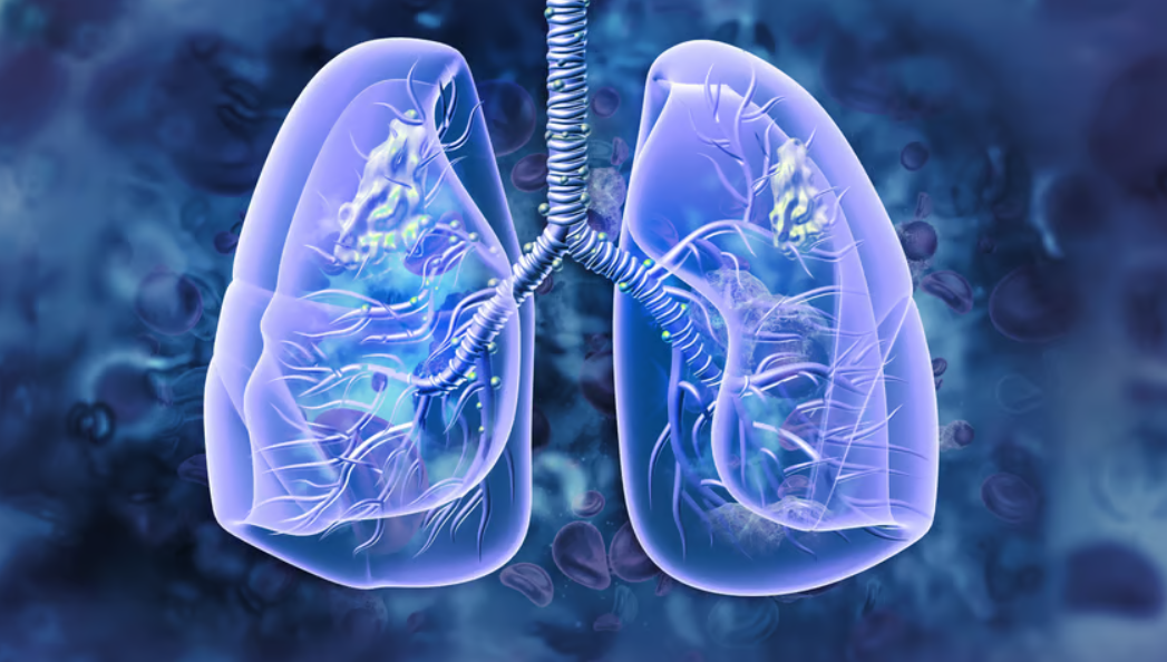 Osimertinib could change the standard of care for EGFR-mutant NSCLC