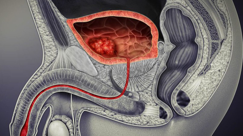 How the gut microbiome may influence chemotherapy response in urothelial carcinoma