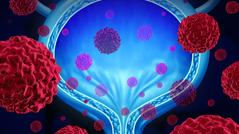 Using cDNA testing to guide immunotherapy for Bladder Cancer post-surgery – PRIMR